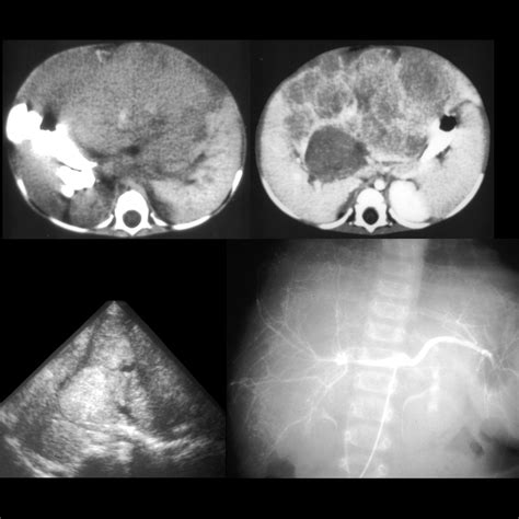 pediatric hepatomegaly scan